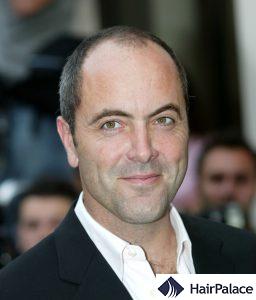 Celebrity Hair Transplants How James Nesbitt Credits Hair