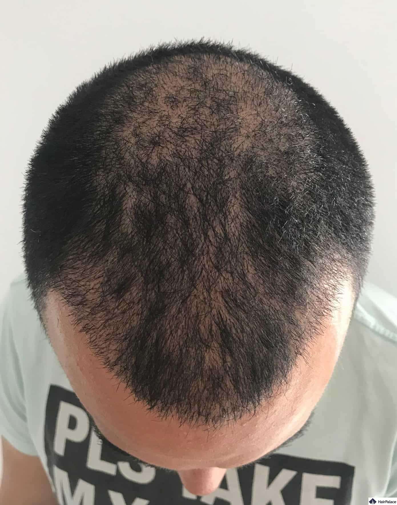 Második kontrollkép 3 héttel a kezelés után. A fejbőrön már nincsenek pörkök, és a beültetett hajak többsége a helyén van.