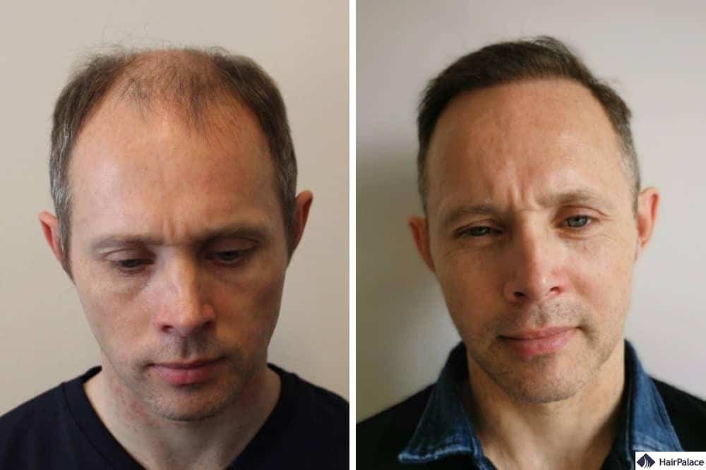 Tom's Two Hair Transplant Sessions - HairPalace