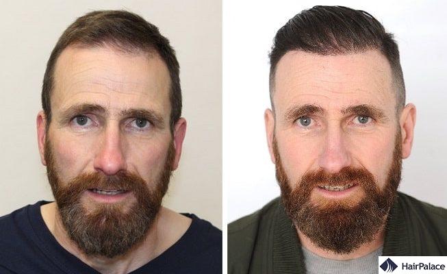 A Small Procedure with a Great Result – Andrew's Hair Transplant Surgery -  HairPalace