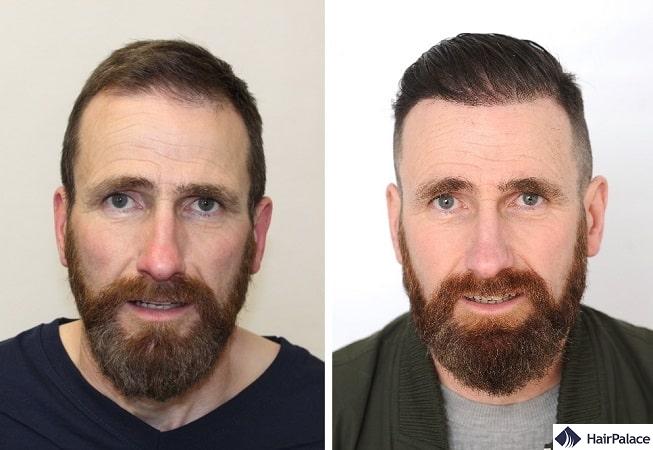 A Small Procedure with a Great Result – Andrew's Hair Transplant Surgery - HairPalace A Small Procedure with a Great Result – Andrew's Hair Transplant Surgery - HairPalace