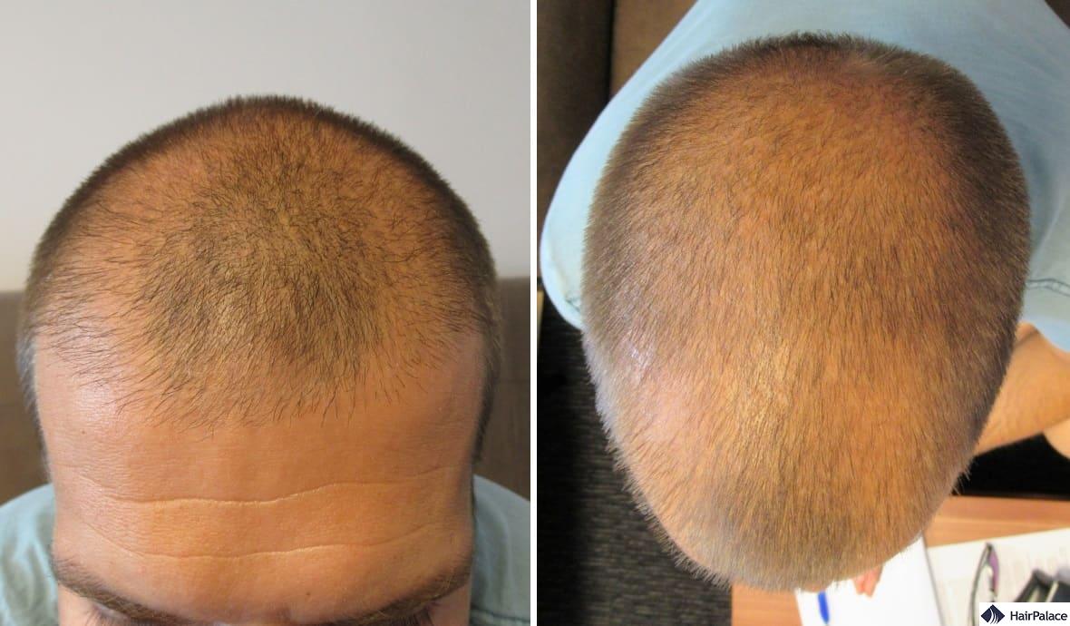 Thinning at the hairline and front, and at the crown as seen at the consultation before the hair transplant