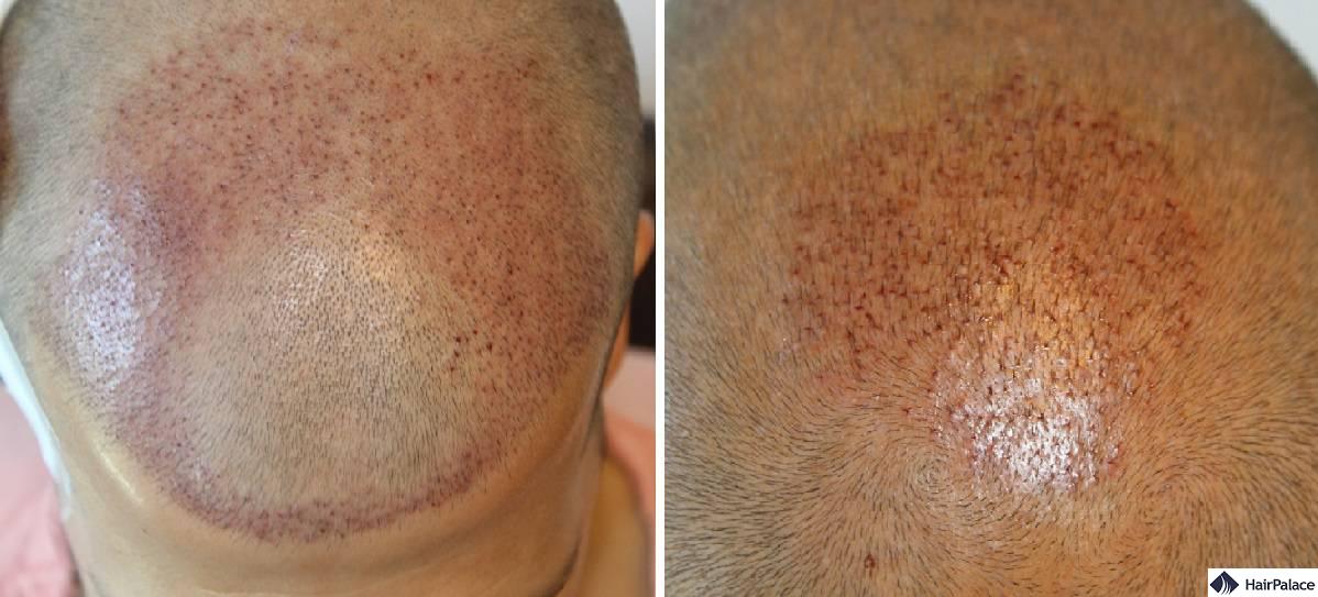 Distribution of the hairs at the front and crown immediately after the hair transplant