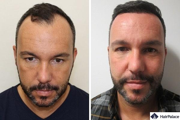 Jerome before and after his hairline hair transplant