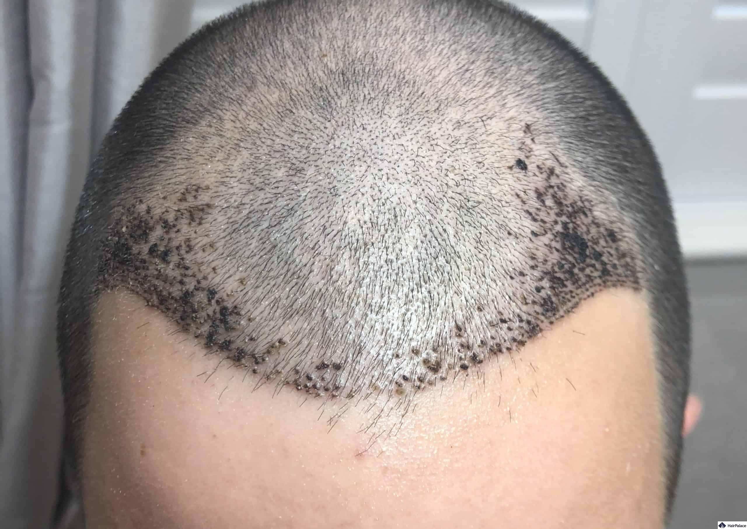 Kristóf hajvonala 7 nappal a FUE2 műtét után. A fotón jól láthatóak a pörkök a beültetett területen