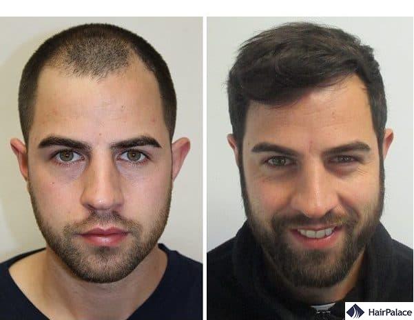 Natural-looking Hair Transplant: How Can It Be Done? - HairPalace