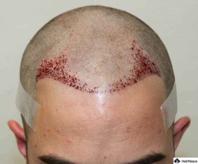 Close-up photo of Chriss hairline after the hair transplant is finished.