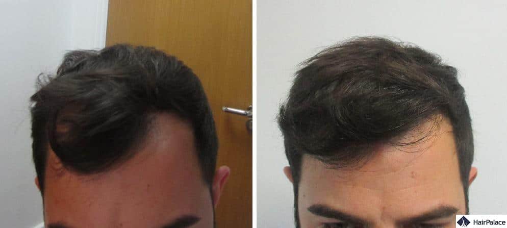 Closeup photos of the frontal area before and after Chris' surgery, showing the change and the natural-looking hairline he achieved with the hair transplant