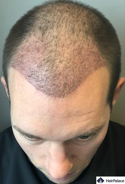 This 3-weeks' check-up photo shows some light redness on the recipient area. The scabs are gone and the scalp is clean, and there are a few hairs missing as they have already started to fall out.