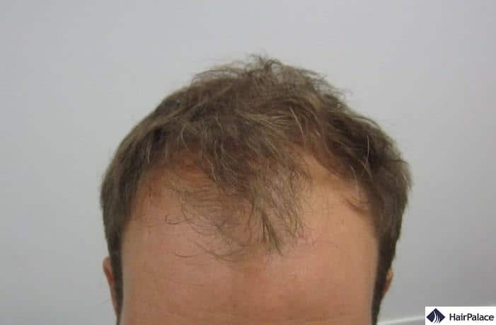 Photo taken at Toby's examiantion showing the extent of hairloss at the front