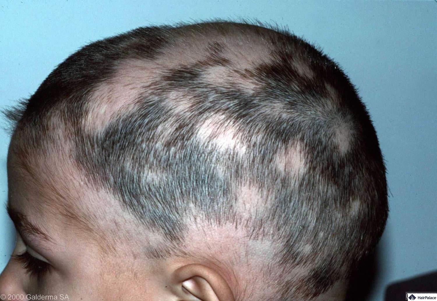 alopecia areata hair loss