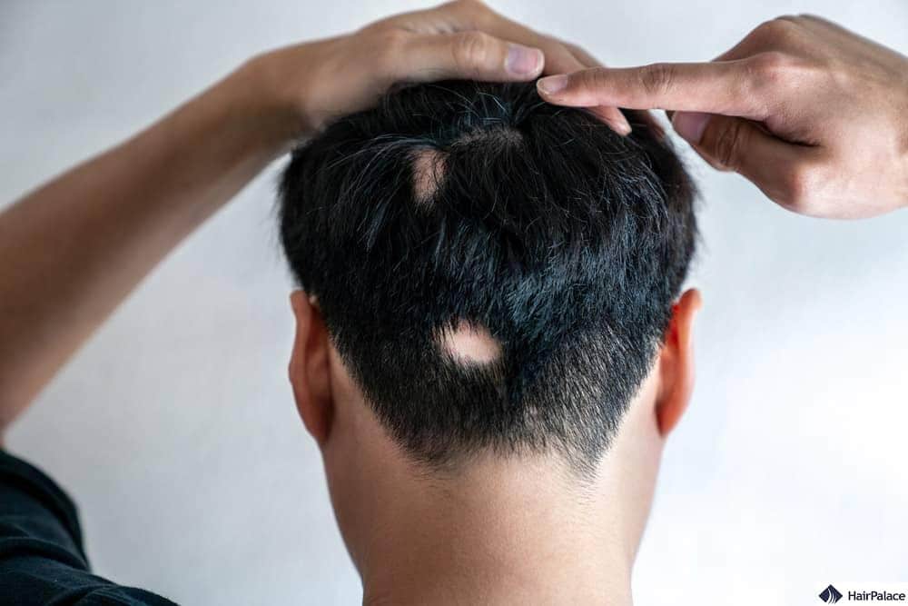 alopecia areata