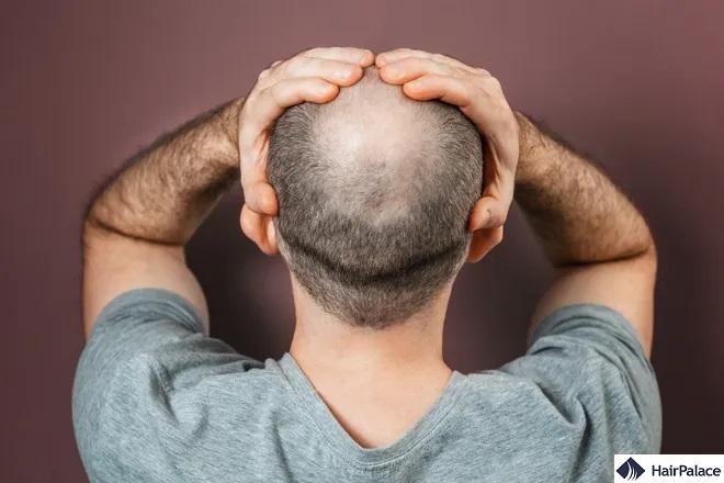 hair loss causes