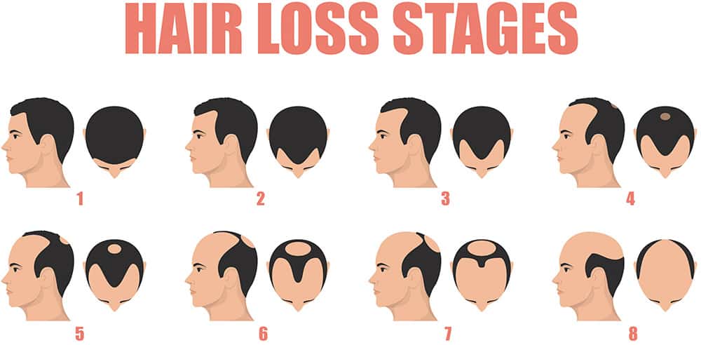 stages of male pattern baldness