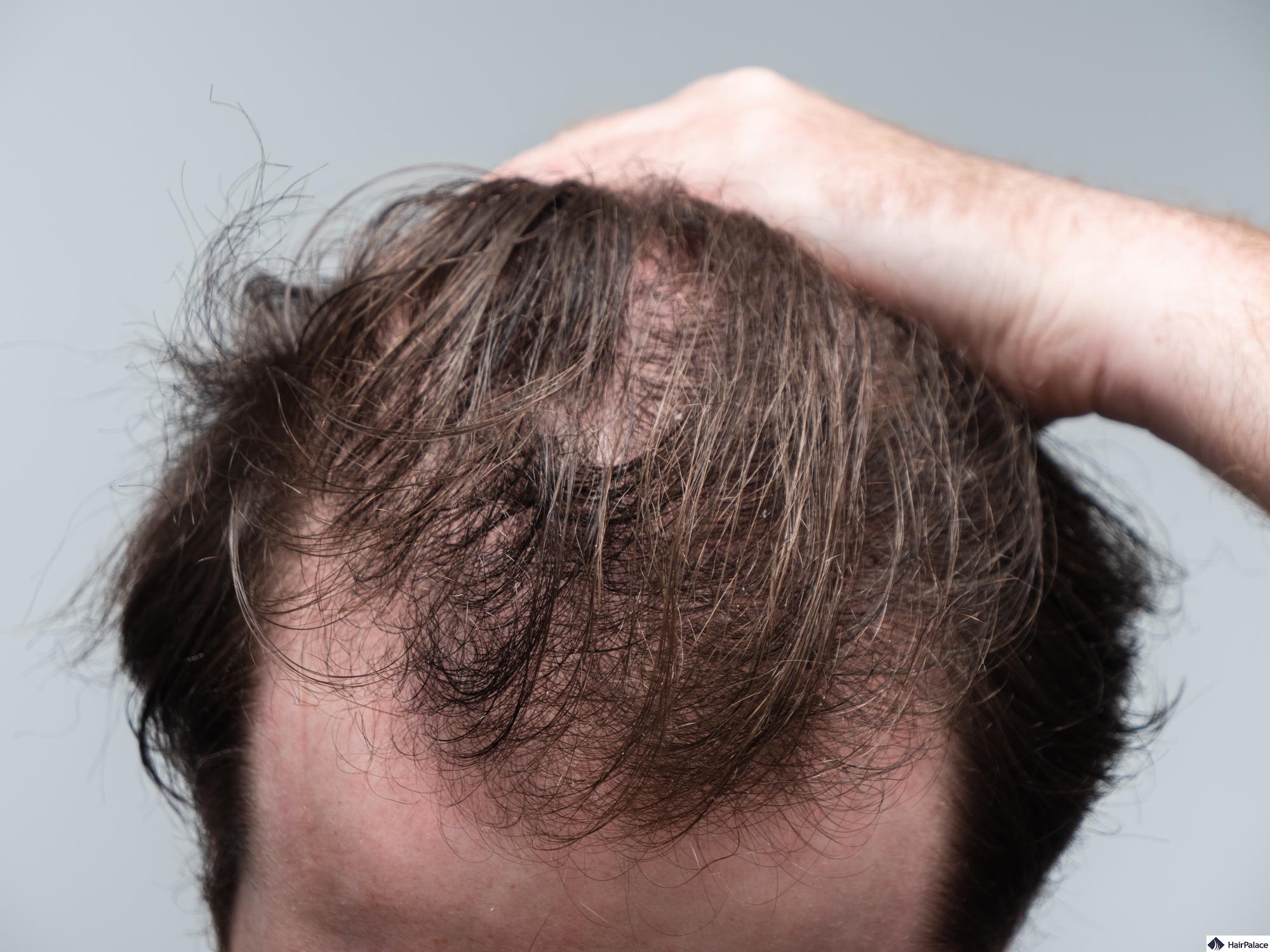 Telogen Effluvium Causes Symptoms And Treatments telogen-effluvium-causes-symptoms-and-treatments