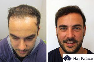 best hair transplant in France