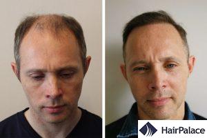 FUE hair transplant in Switzerland