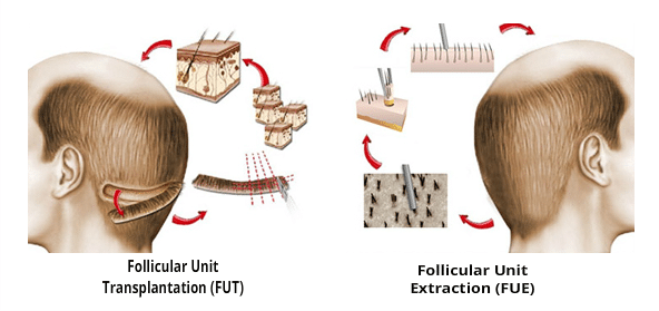 Modern techniques ensure that the result of the hair transplant last life-long