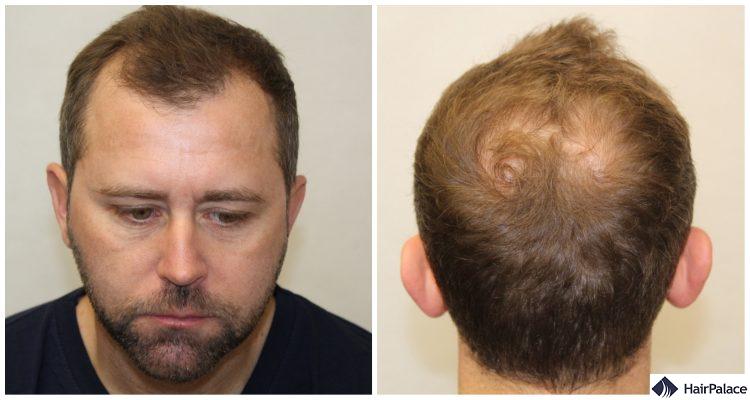 Neil's Stunning Hair Transplant Result After 12 Months - HairPalace
