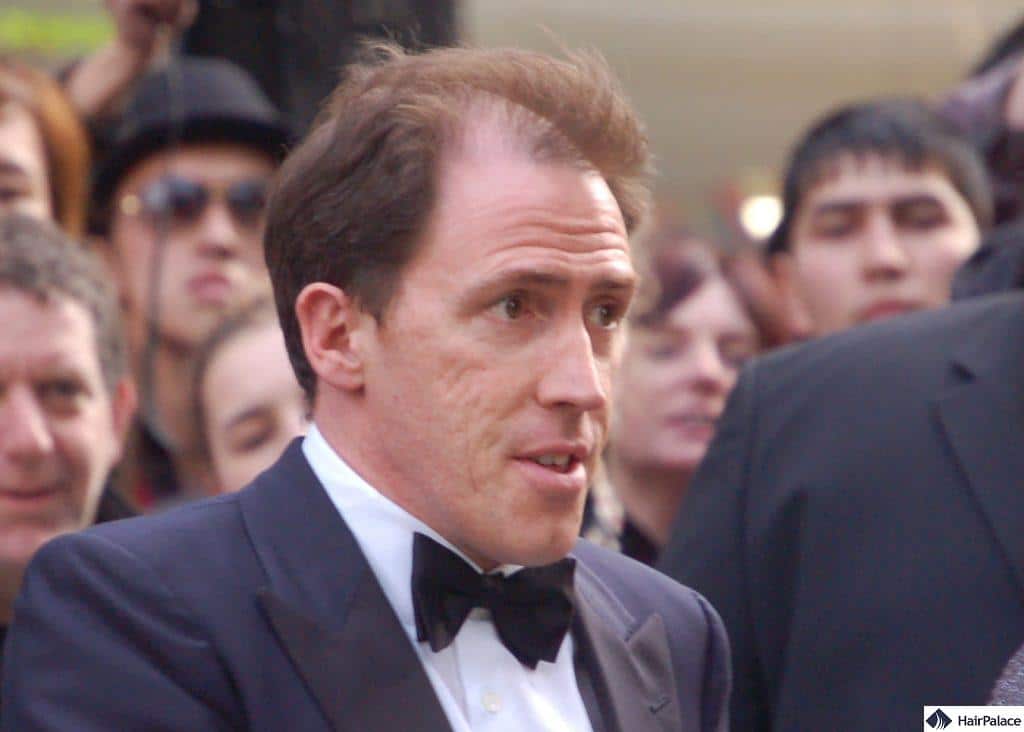 Rob Brydon's hair loss in 2008