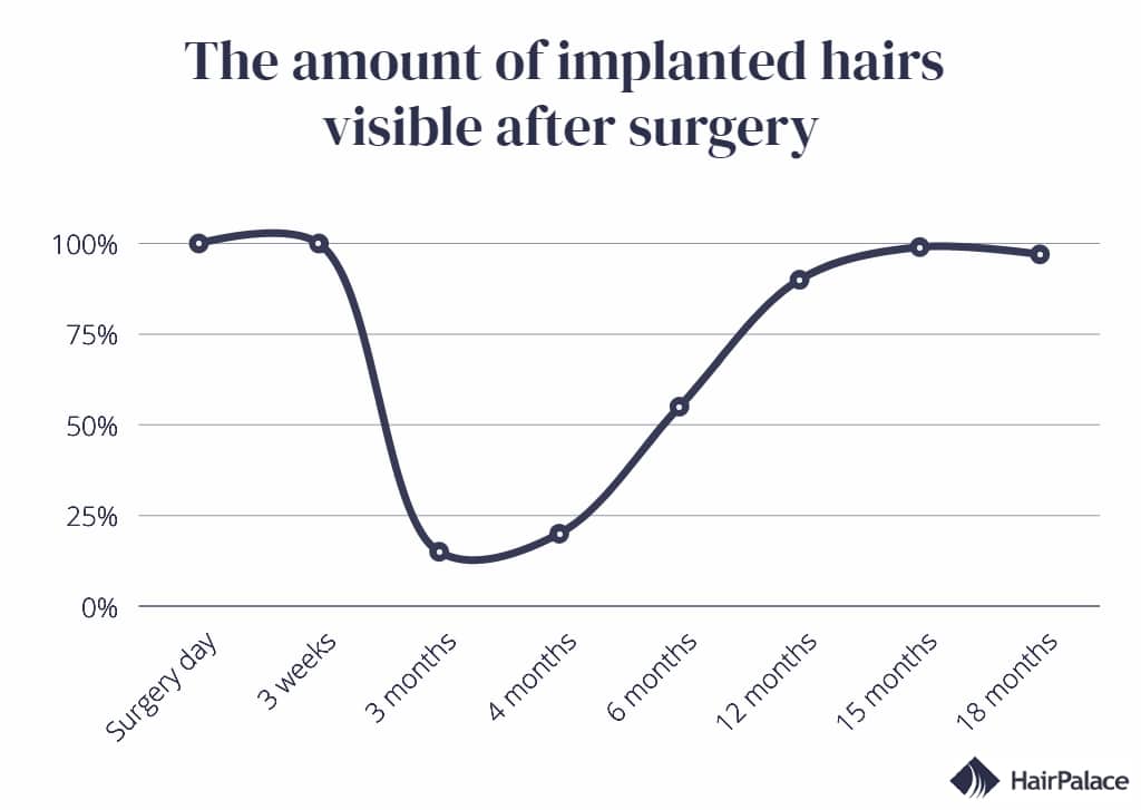 timeline of the amount of implanted hairs visible after hair transplant