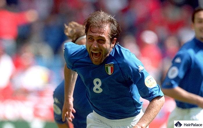 Antonio Conte hair transplant in 2000