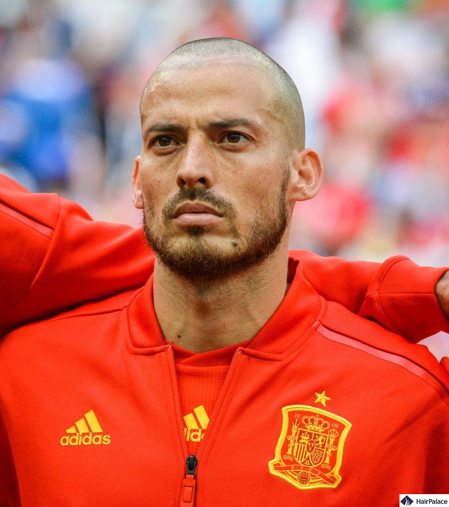 David Silva hair transplant FUE