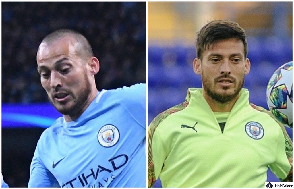 David Silva hair transplant before after FUE result