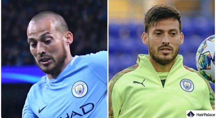 David Silva hair transplant before after FUE2 result