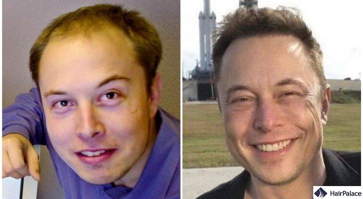 Elon Musk Hair Transplant | The Secret of His Amazing Result