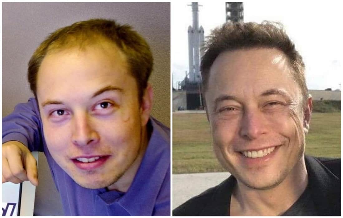 Elon Musk Hair Transplant Journey Step by Step