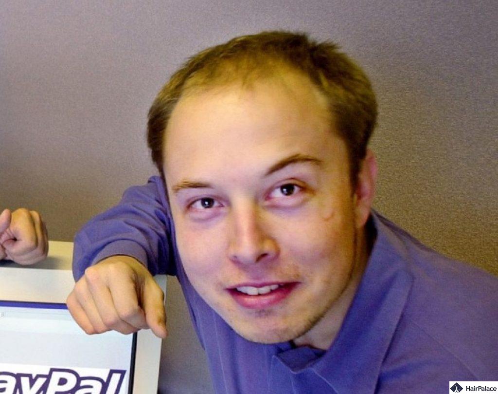 Young Elon Musk suffering from hair loss