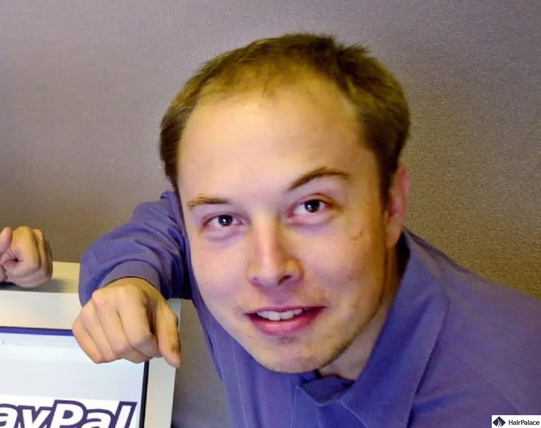 elon-musk-young-hairloss-1.jpg.webp