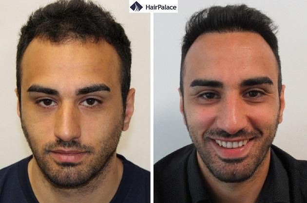 How Long Does a Hair Transplants Last in 2023? How Long Does a Hair Transplants Last in 2023?