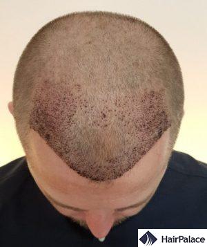 Neil 1 week after the FUE2 transplant