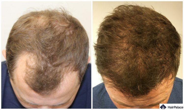 Neil's hair before and 12 months after the surgery