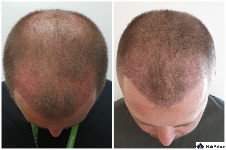 Neil's hair 3 weeks and 3 months after the procedure