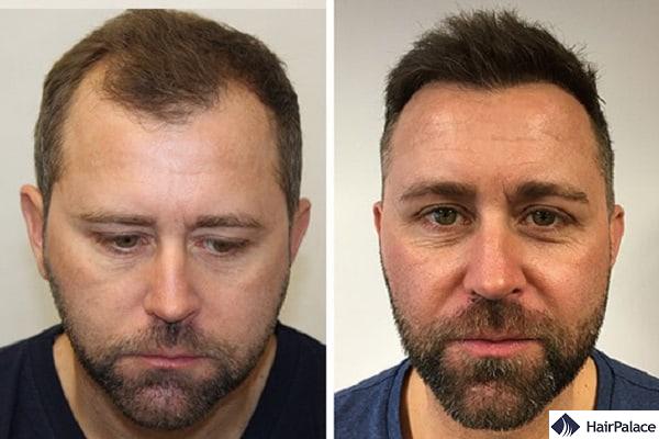 Neil before and after our hair transplant