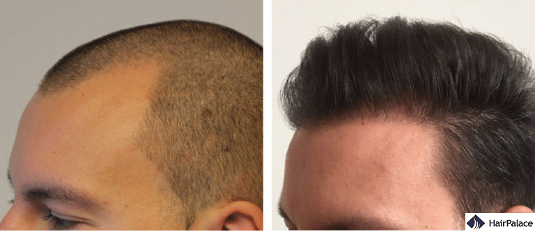 The result of the modern FUE2 Safe System hair transplant method