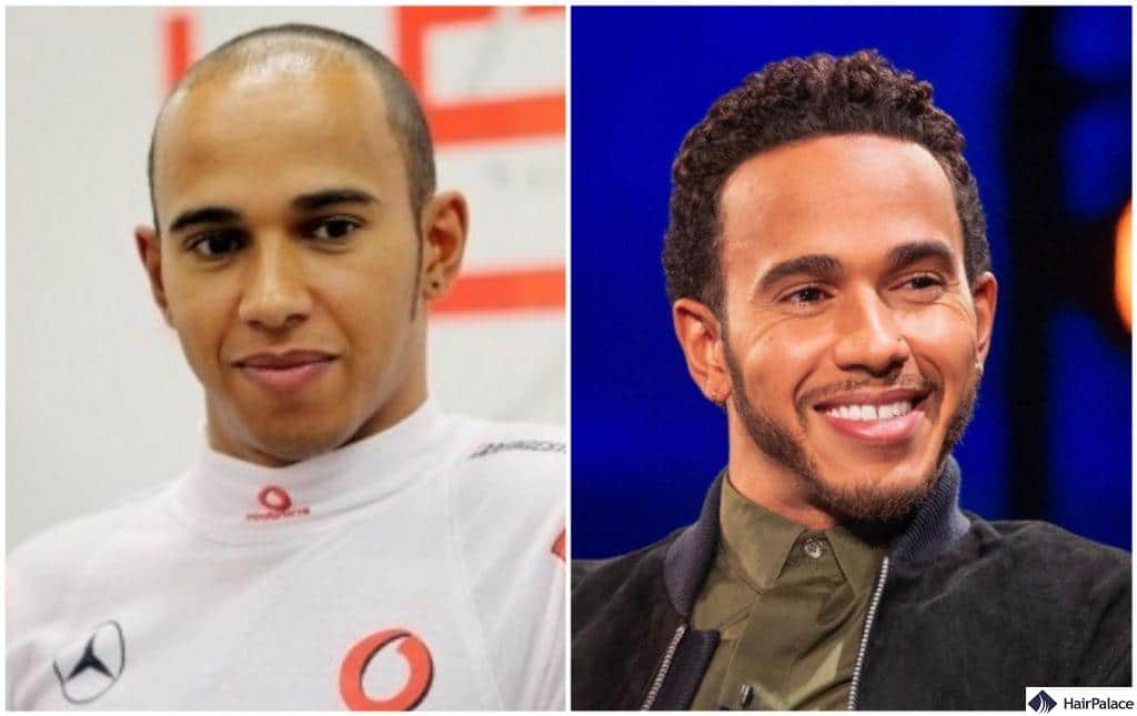The Whole Story about Lewis Hamilton Hair Transplant