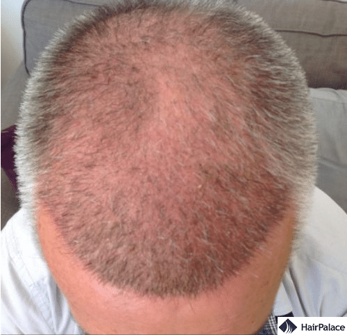 Pascal 3 weeks after the hair transplant