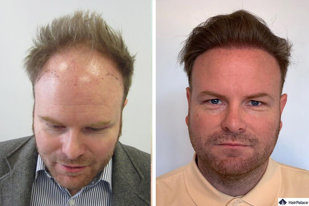 hair transplant result