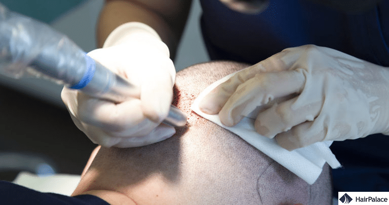 The revolutionary FUE2 hair transplant method