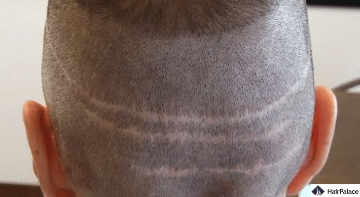 hair transplant and scars