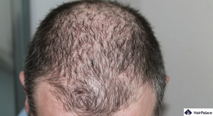 The best hair loss forum sites for men and women