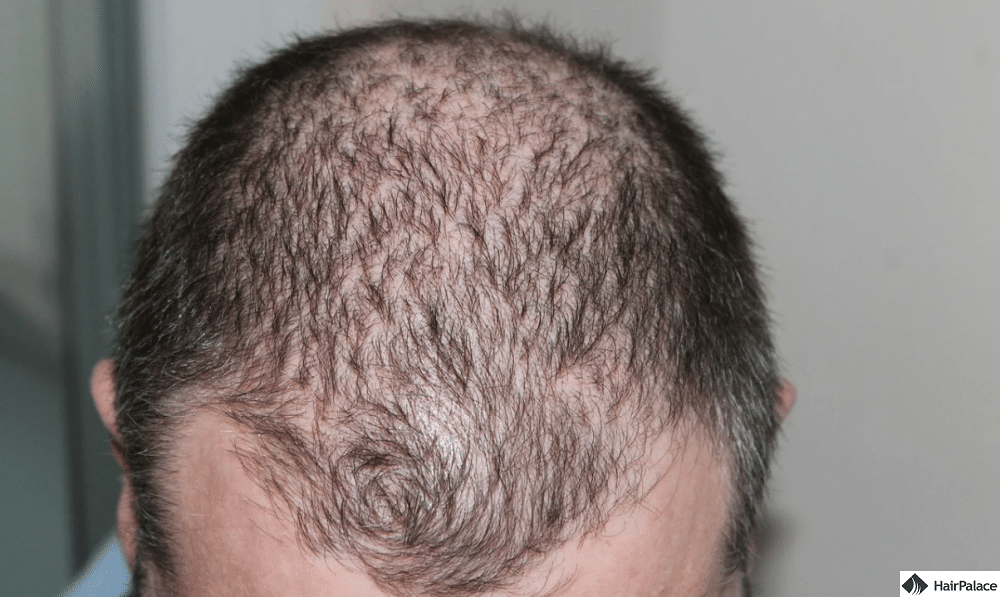 hair transplant cost turkey forum