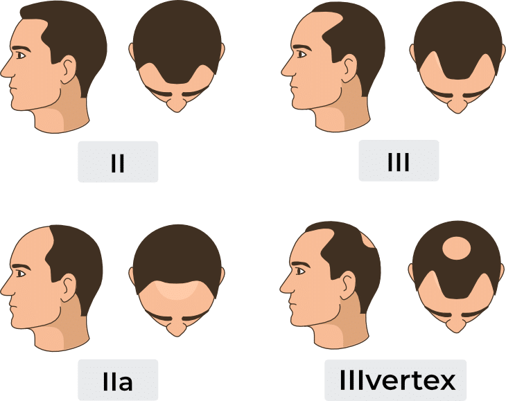Hair Transplant crown area before and after, crown hair transplant cost uk