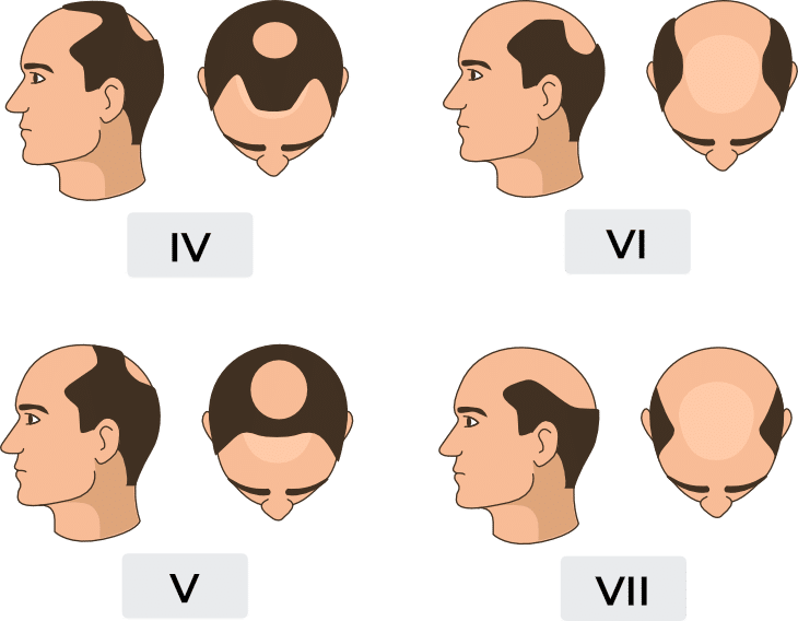 haartransplantation billig