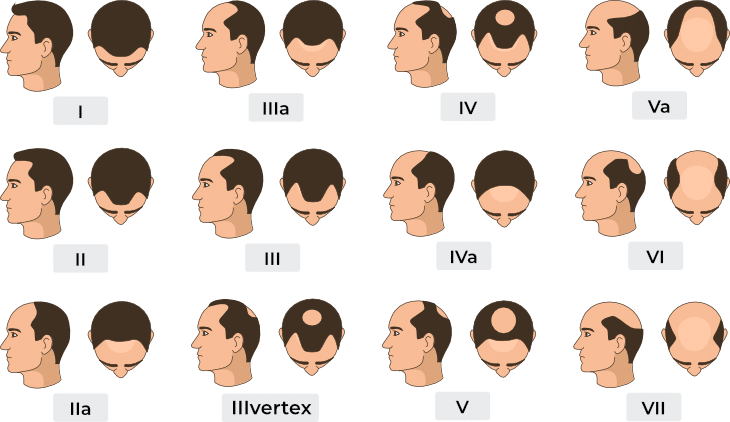 haartransplantation Kosten