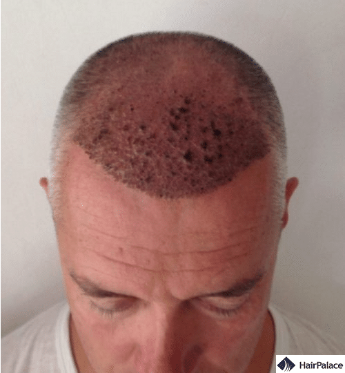 Pascal 1 week hair implantation result